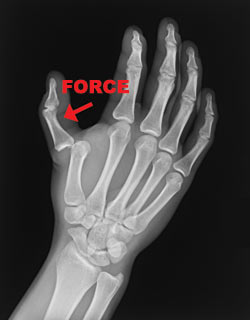 Broken skier's thumb