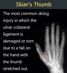 Skier's thumb - a common skiing injury