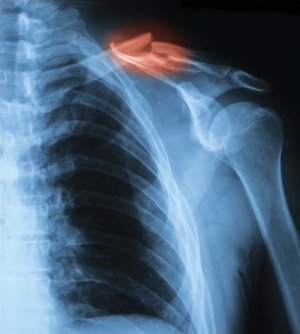 Acromioclavicular joint injury