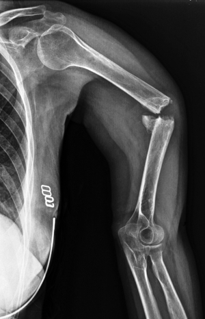 Humerus fracture